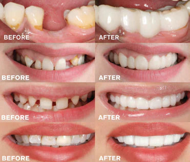 Foldable Teeth Set - Buy One, Get One Free
